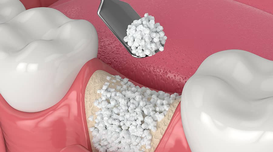 About bone grafting