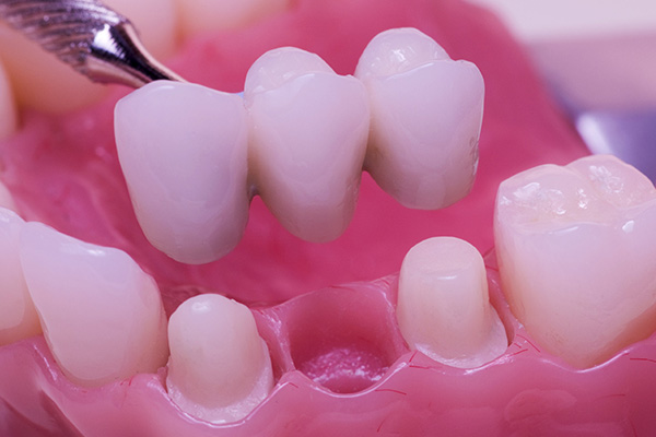 Replacing Missing Teeth