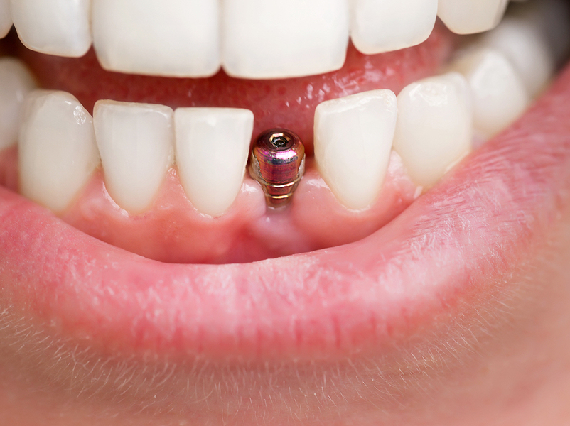 Dental Implant