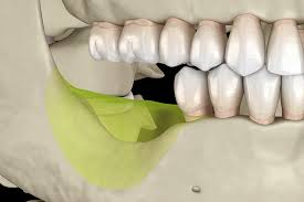 Jaw Bone Loss and Deterioration