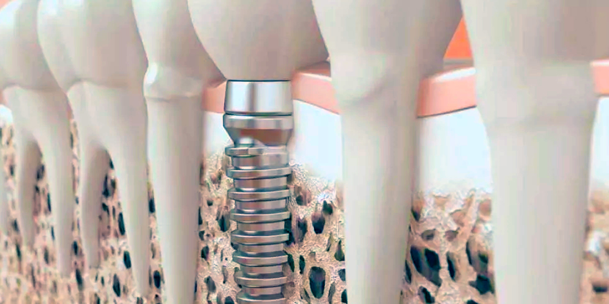 Dental Implants