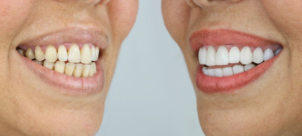 Before And After Smile Makeover How Restoring A Perfect Smile Improve Your Mental Health